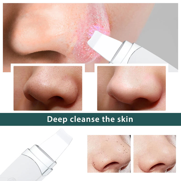 Ultrasonic Derma Skin Scrubber Pen